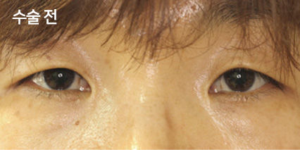 수술 전