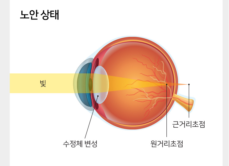 노안 상태